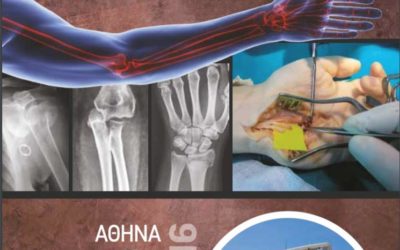 Αναλύοντας το Τραυματικό Πρόσθιο Εξάρθρημα Ώμου